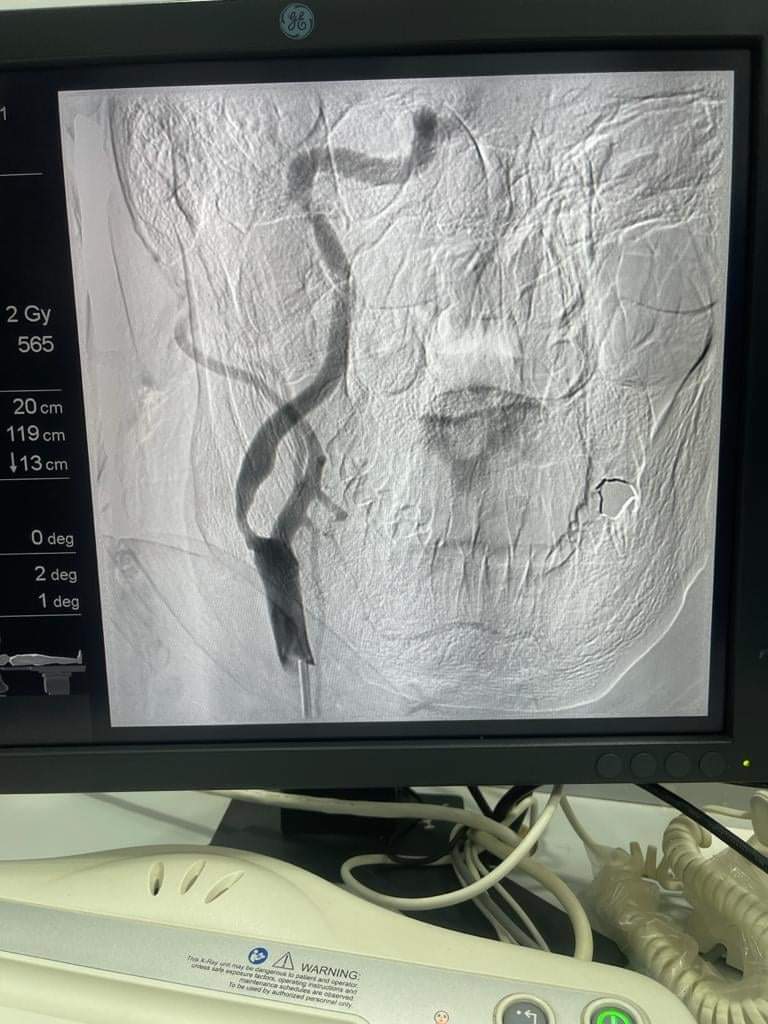 إجراء أول قسطرة مُخية لحالتين في الفيوم