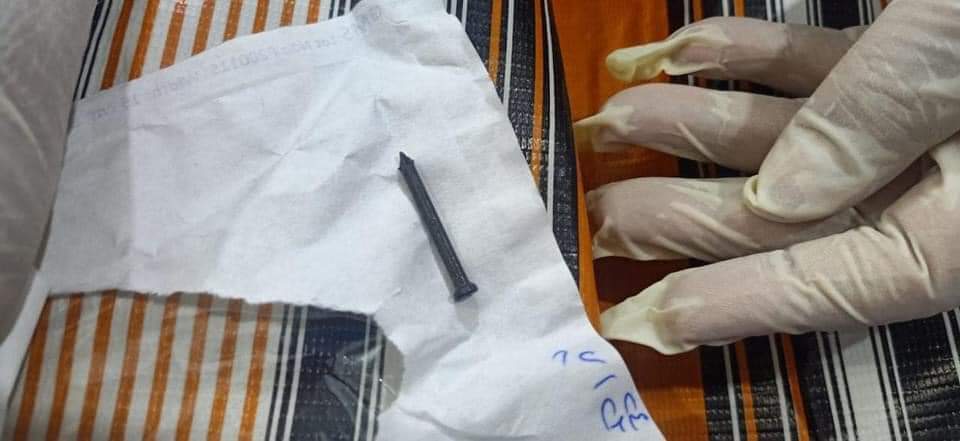 المسمار بعد استخراجه من معدة الطفل