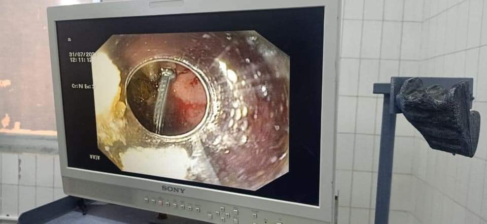 المسمار داخل معدة الطفل 01