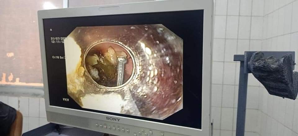 المسمار داخل معدة الطفل 02