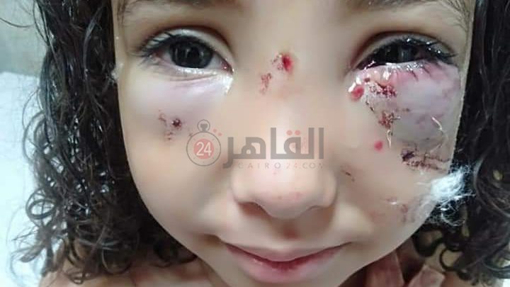 احد الأطفال المصابين 