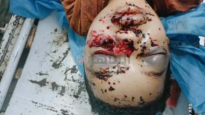 احد الأطفال المصابين 