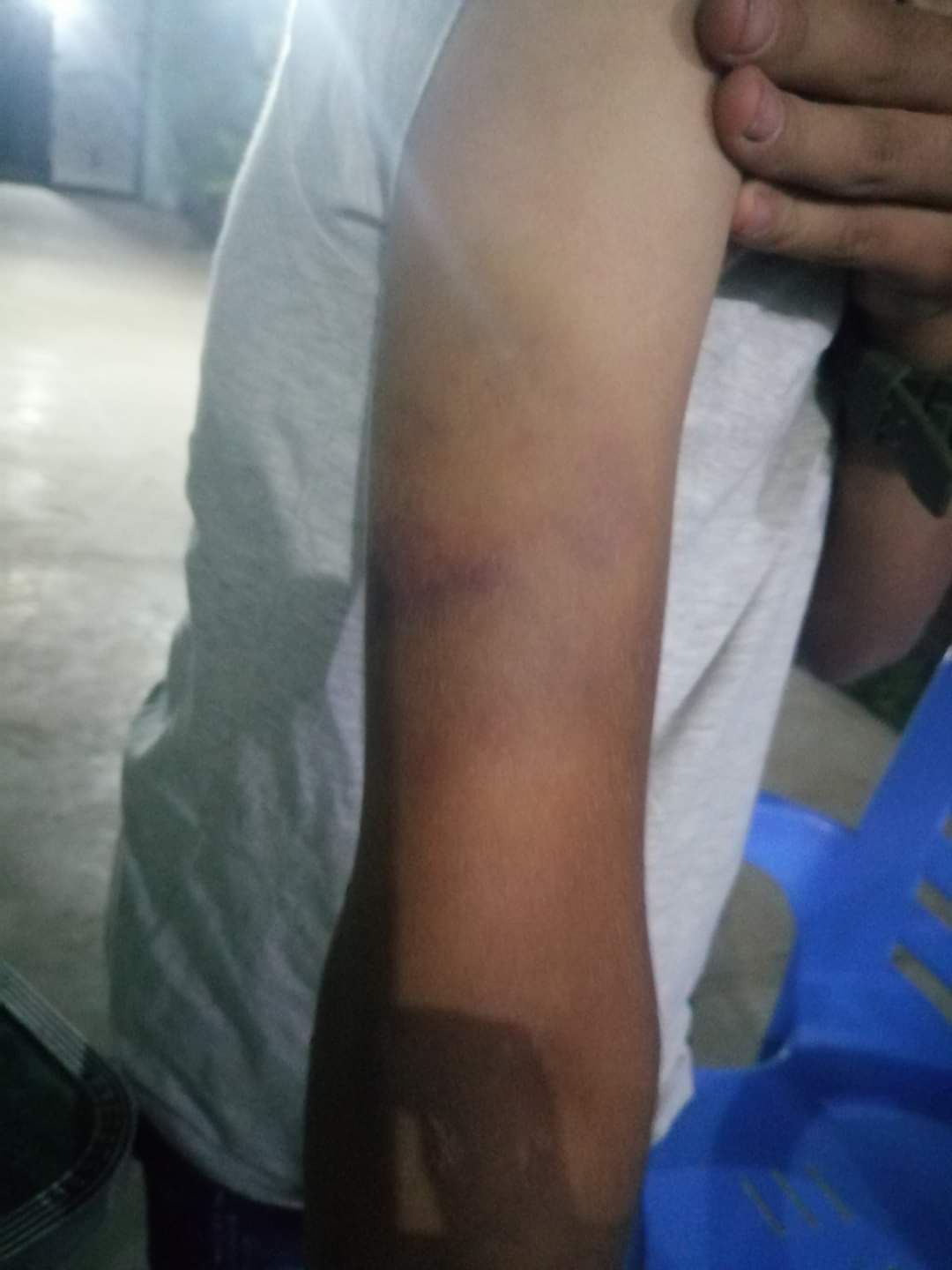 أثار التعذيب على جسد الطفل 2