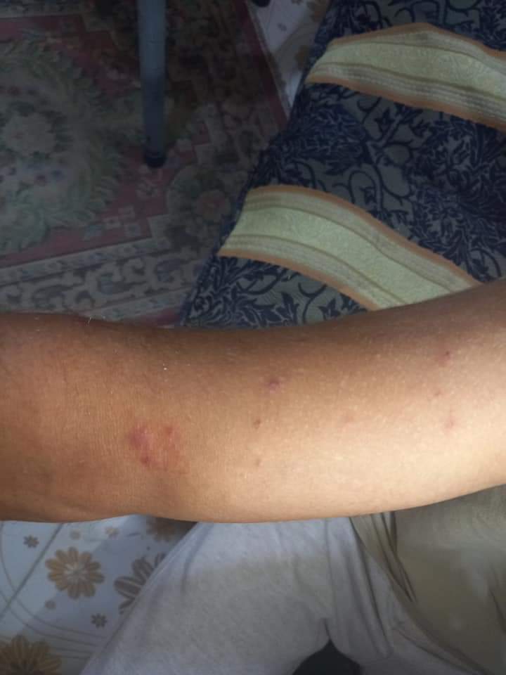 تعرض مواطنين للسعات قنديل البحر 