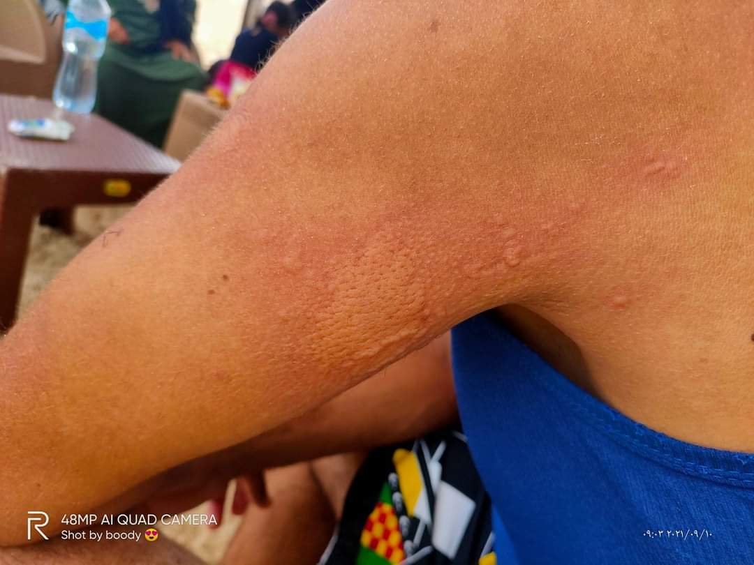 تعرض مواطنين للسعات قنديل البحر