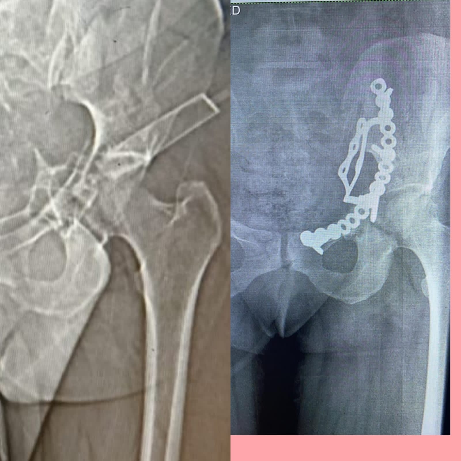 إجراء عملية إصلاح كسور متعددة مفتتة بالحوض لأول مرة بالشرقية 02