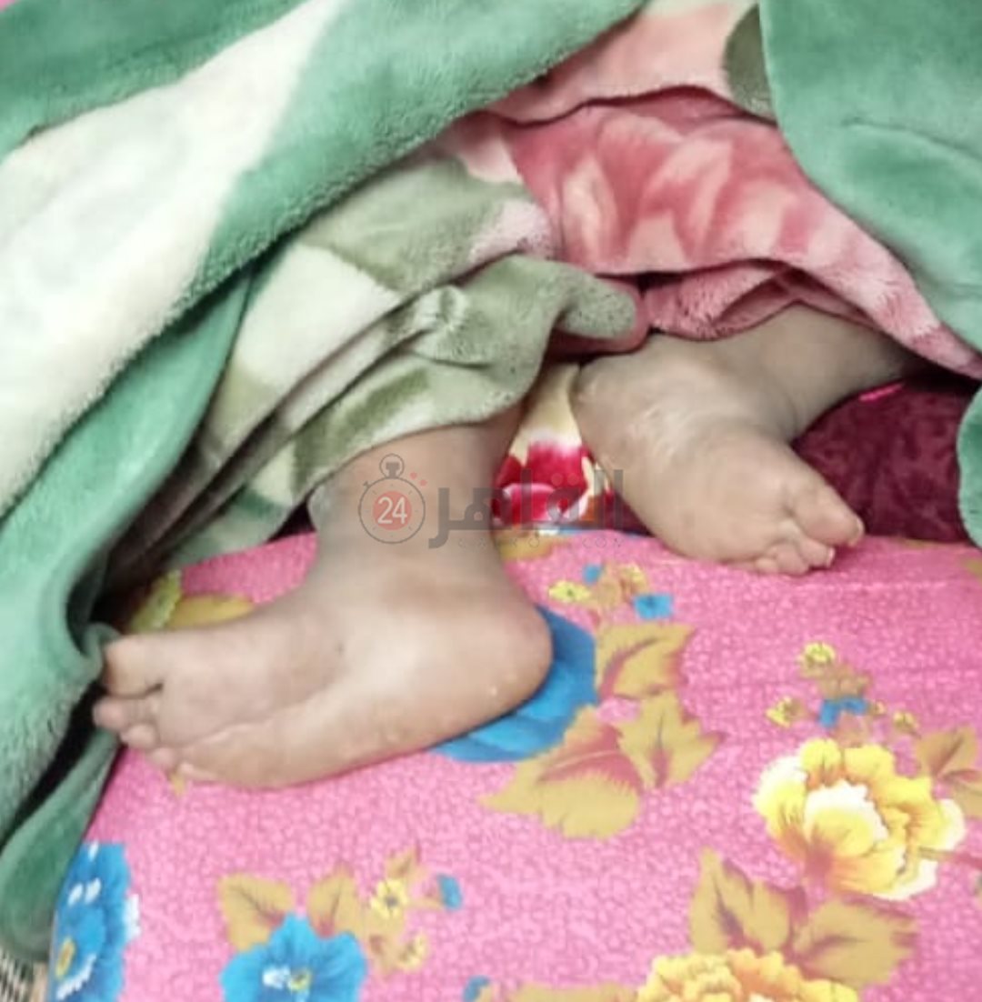 قدم السيدة المريضة