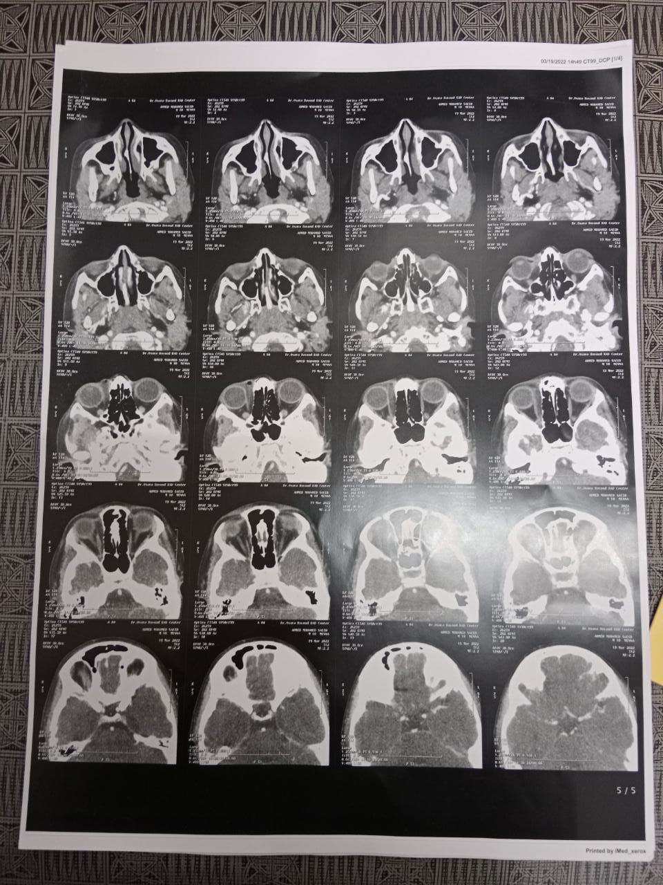 أشعة على عين المريض