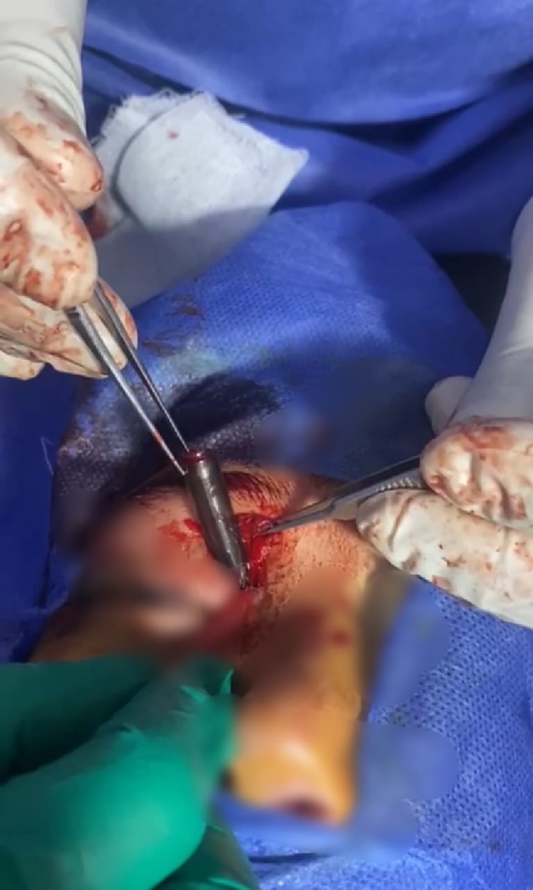 استخراج قلم من عين مريض بالشرقية