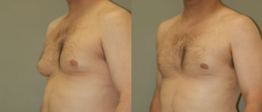 علاج التثدي عند الرجال