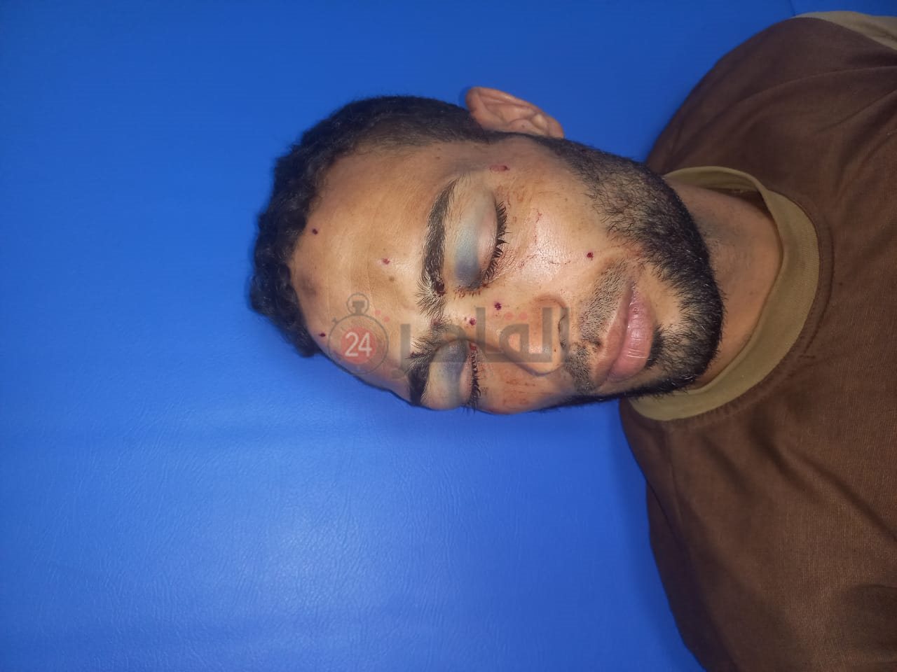 الشاب المصاب بطلقات خرطوش