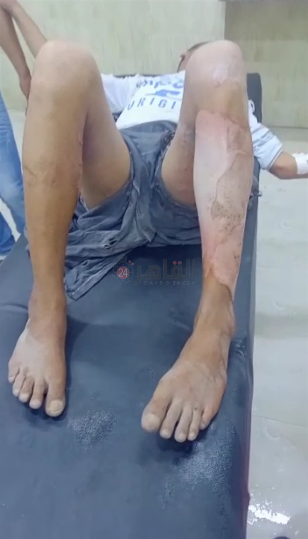 آثار الحروق على ساق المجني عليه الثاني
