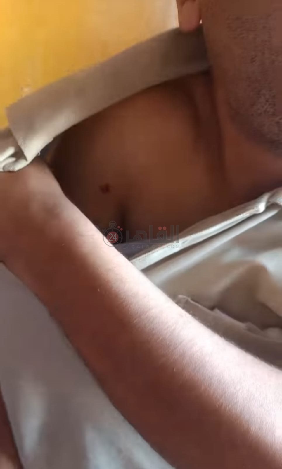 آثار عقر القلب في كتف المصاب الثاني