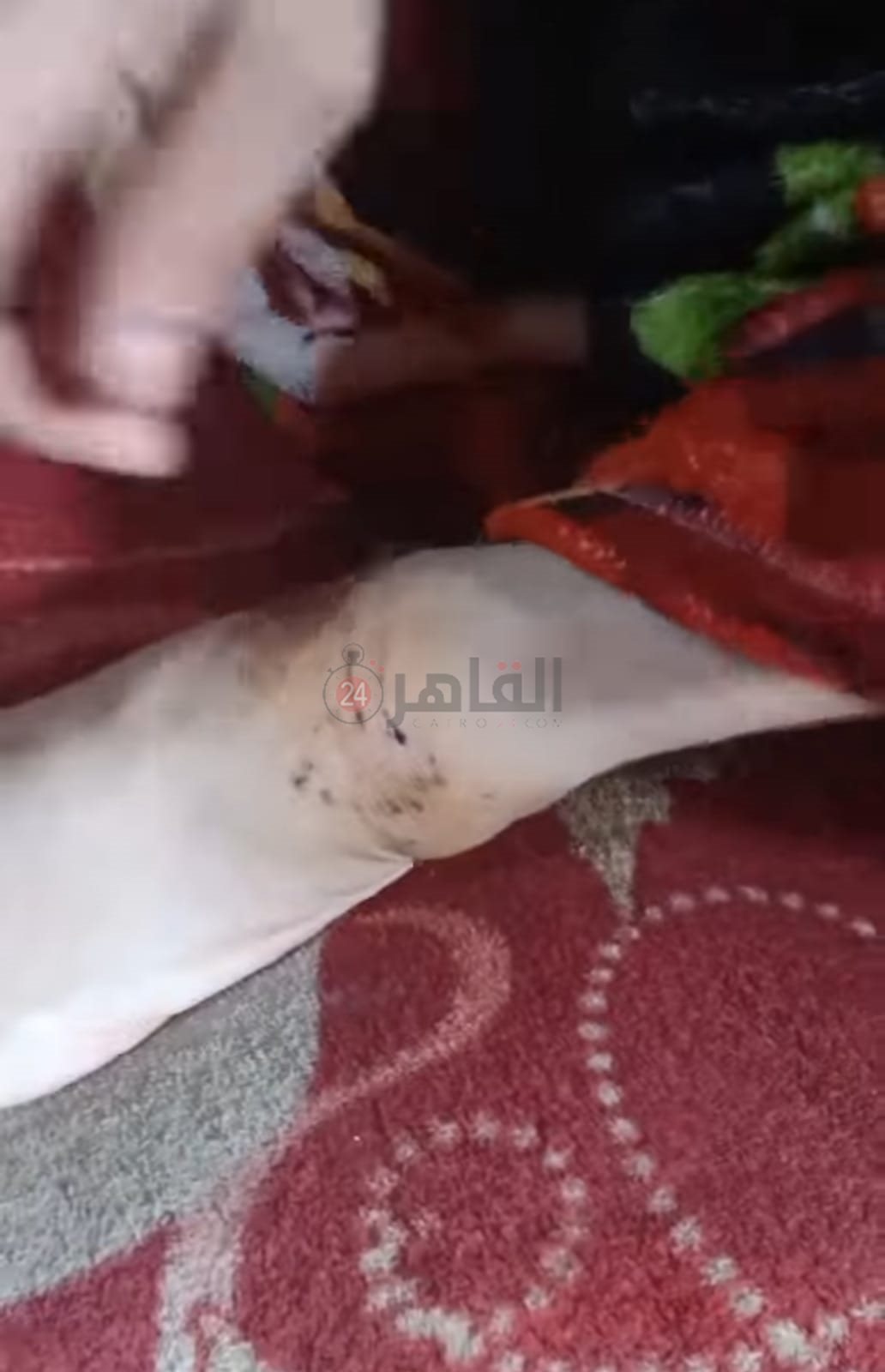 آثار عقر الكلب في قدم المصابة