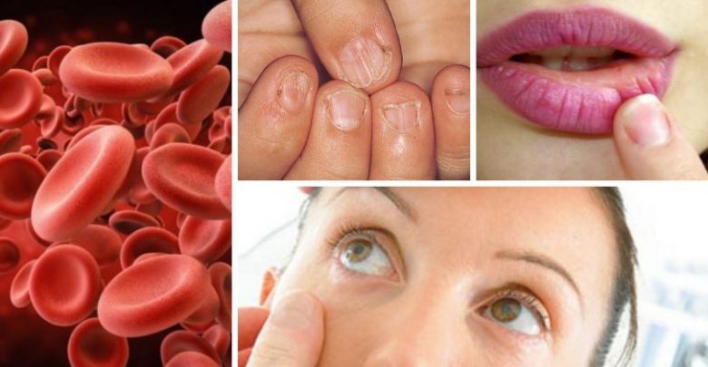 أعراض نقص الحديد في الجسم