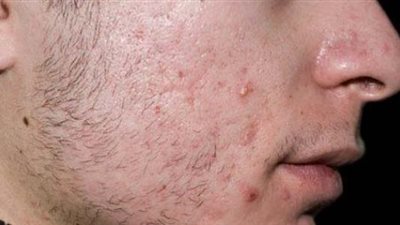 خبيرة تغذية تكشف الأطعمة التي تخلصك من حب الشباب