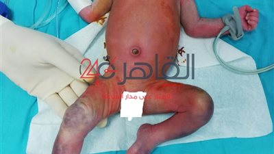 وفاة طفلة بإشعاع زائد فى حضانة مستشفى الشيخ زايد (صور)