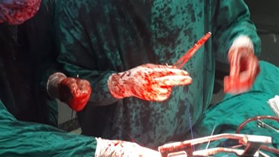 القاهرة 24 ينفرد بتفاصيل 3 ساعات لإنقاذ قلب مريض من طعنة نافذة 