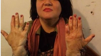 فتاة تناشد السيسي رعاية مصابي الحروق وتخصيص وظائف حكومية ومعاشات لهم