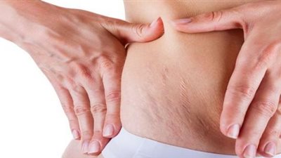 نصائح هامة للتخلص من علامات الجسم “السيلوليت” بأقل التكاليف ودون عناء