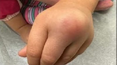 طفلة تصاب بعدوى بكتيرية نادرة بعد أن عضتها سحلية