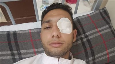 إصابة شاب بنزيف وانفصال في شبكية العين إثر شمروخ ناري أثناء لهو الأطفال ببني سويف