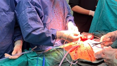 مستشفى الطوارئ بجامعة المنصورة تنقذ حياة شاب مصاب بطعنة نافذة بالقلب