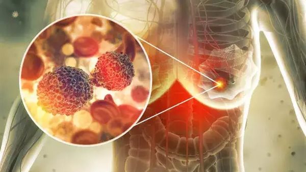 ورم الثدي - تعبيرية