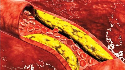 5 عادات تساهم في خفض مستويات الكوليسترول بالدم