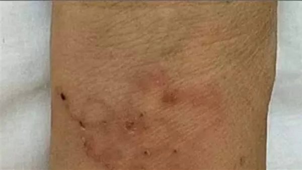 ديدان تحت الجلد