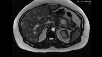 حالة طبية نادرة.. فحوصات تثبت حمل رجل أردني في الشهر الثاني