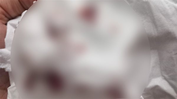 إصابة الزوجة من الحقن