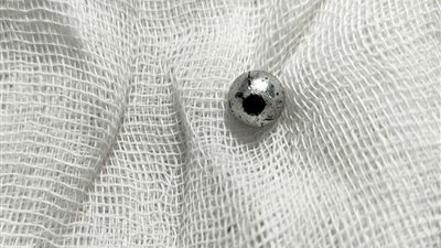 فريق طبي بمستشفى بنها الجامعي ينقذ حياة طفلة ابتلعت 