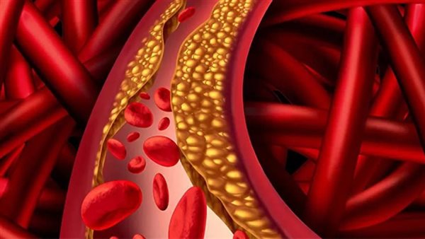 الكوليسترول