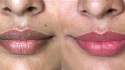 التقشير والترطيب.. طرق فعالة لمنع سواد الشفاه