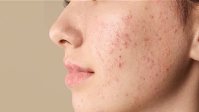هل تعانين من بشرة معرضة لحب الشباب؟.. 3 عادات يومية تساهم في الإصابة 