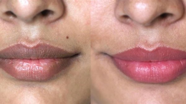 اسمرار الشفاه