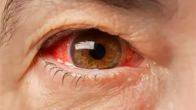 وفاة سنغالي إثر إصابته بحمى الكونغو السيئة ومخاوف من تفشي المرض