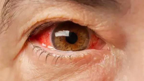 نزيف العين _ تعبيرية