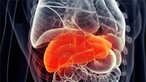 مرض الكبد الدهني