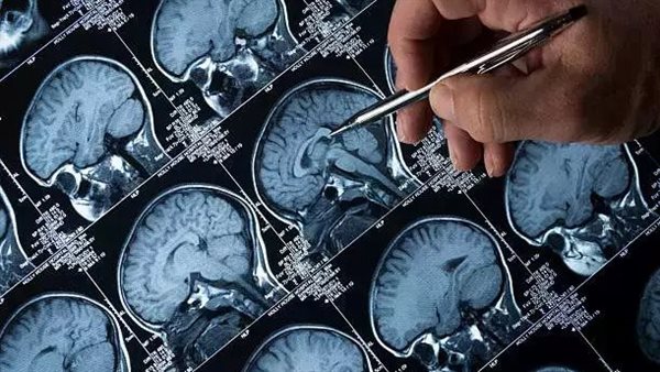 أورام الدماغ 