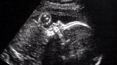 إجراء أول جراحة دماغية لـ جنين داخل رحم والدته مصاب باضطراب مميت 