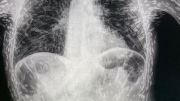 الأشعة السينية