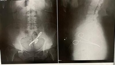استخراج آلة جراحية ظلت داخل بطن سيدة بالمنصورة 6 سنوات 