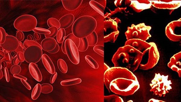 مرض الثلاسيميا 