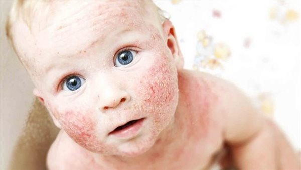  التهاب الجلد التأتبي