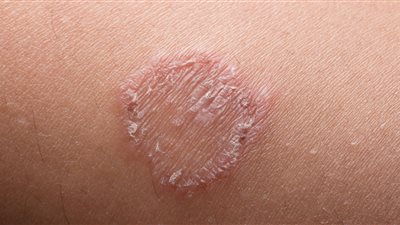 تشخيص أول امرأتين بنيويورك بعدوى فطرية شديدة العدوى مقاومة للأدوية