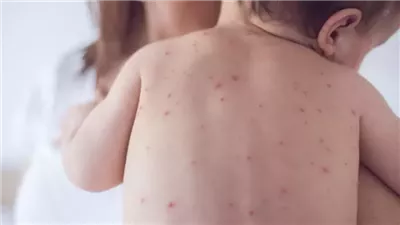 حالة تأهب قصوى في مطار أمريكي بعد رصد إصابة طفل مؤكدة بالحصبة