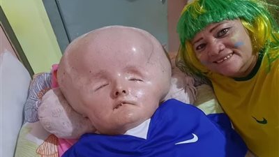 تضاعف رأسها ثلاث مرات.. إصابة شابة بمرض نادر مهدد للحياة 