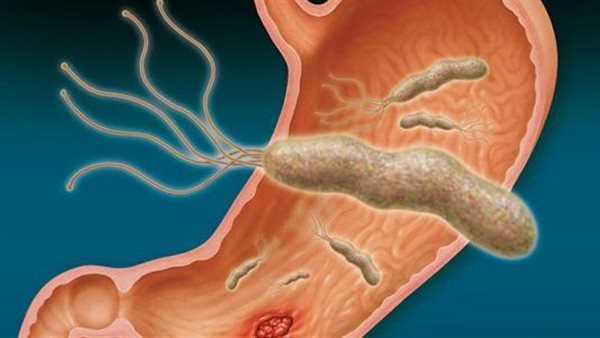 جرثومة المعدة